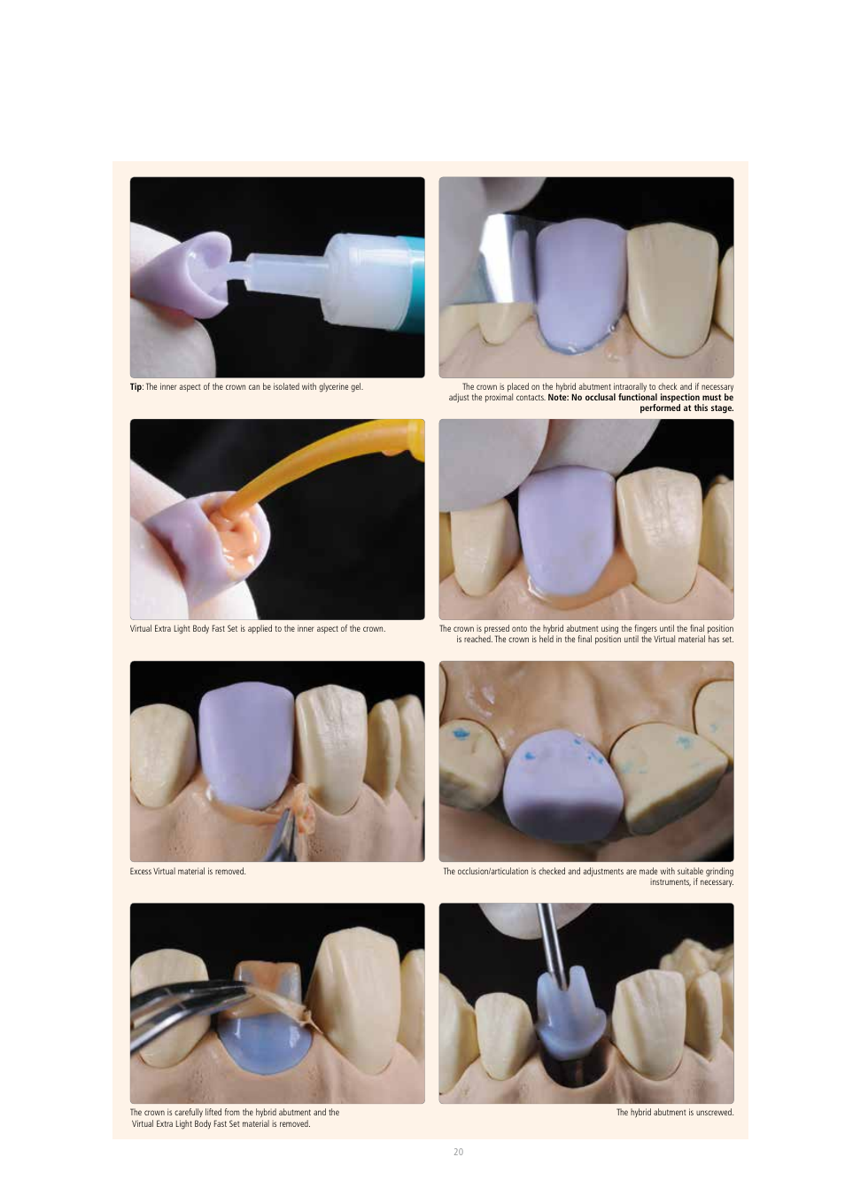 Ivoclar Vivadent IPS e.max CAD Abutment Solutions User Manual | Page 20 / 66