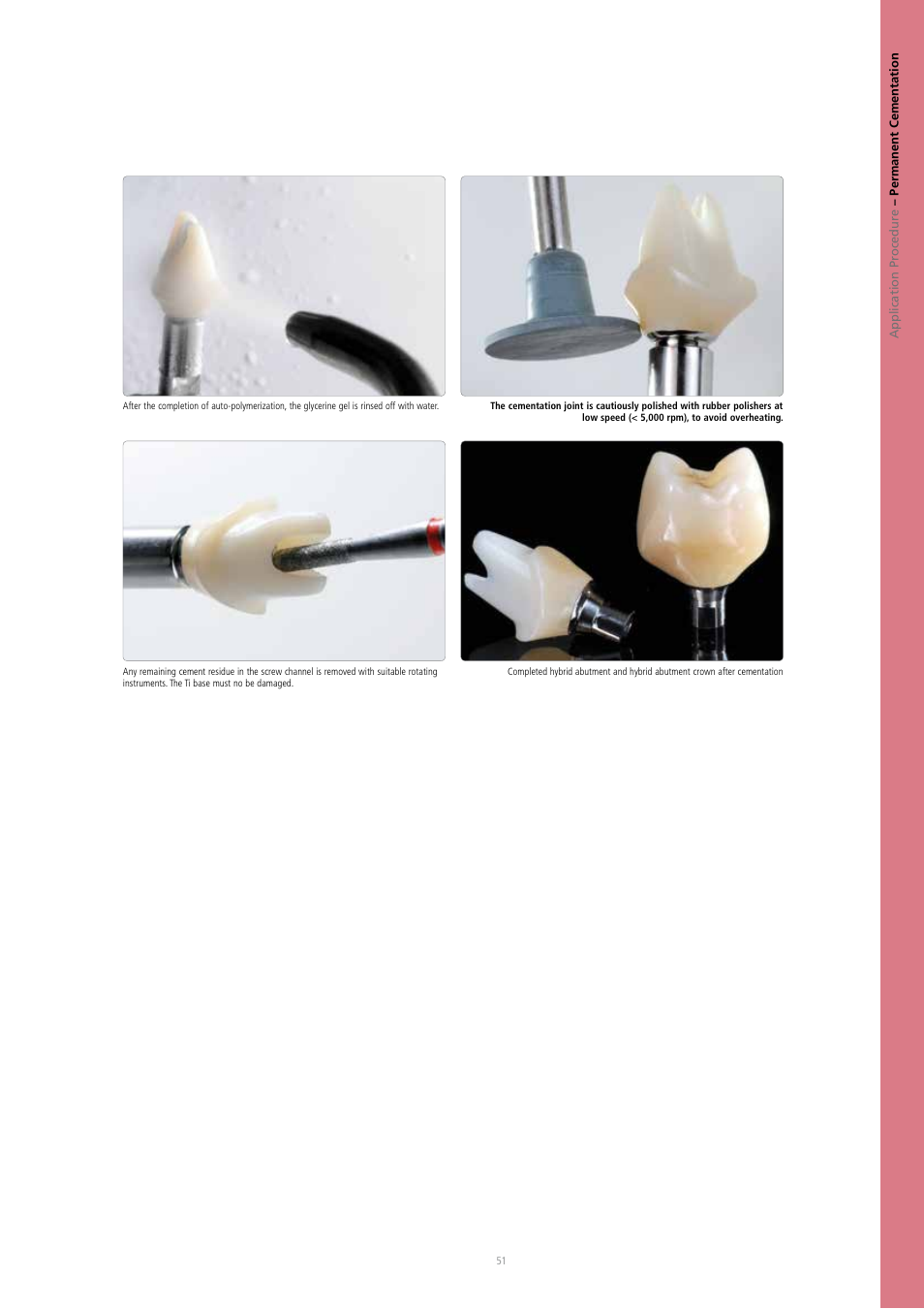 Ivoclar Vivadent IPS e.max CAD Abutment Solutions User Manual | Page 51 / 66