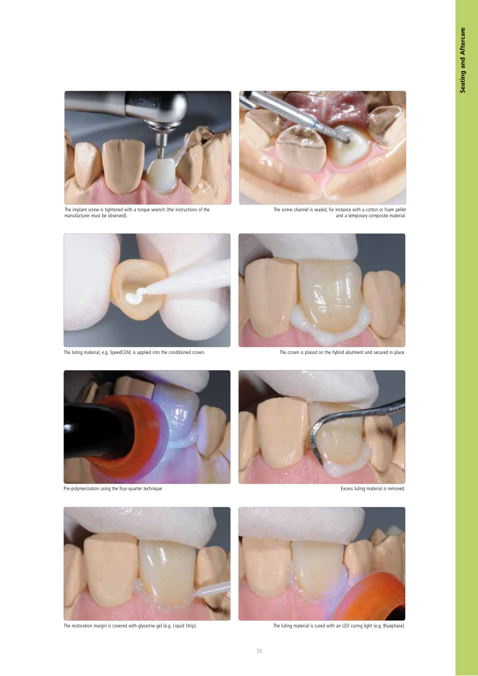 Ivoclar Vivadent IPS e.max CAD Abutment Solutions User Manual | Page 55 / 66