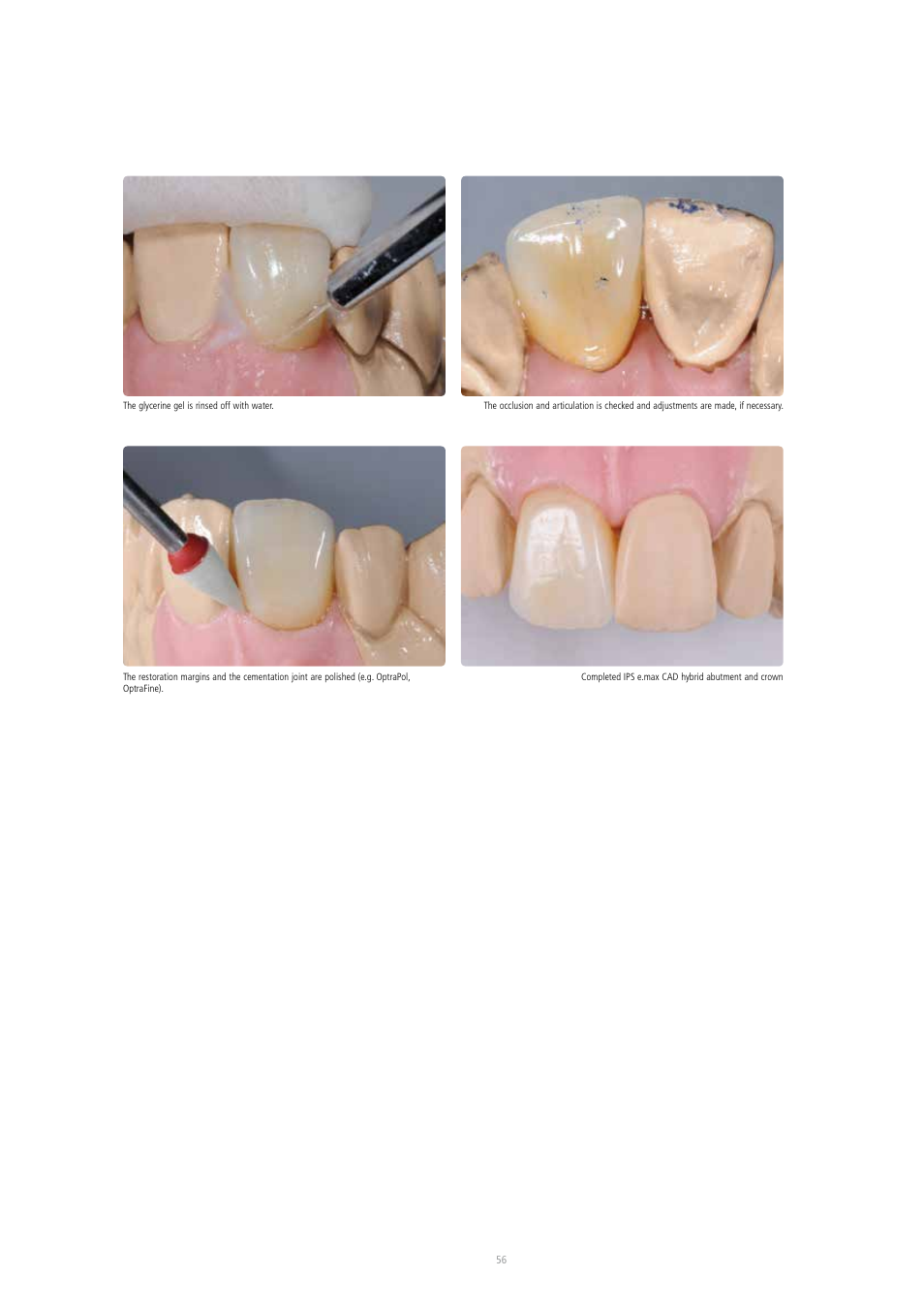 Ivoclar Vivadent IPS e.max CAD Abutment Solutions User Manual | Page 56 / 66