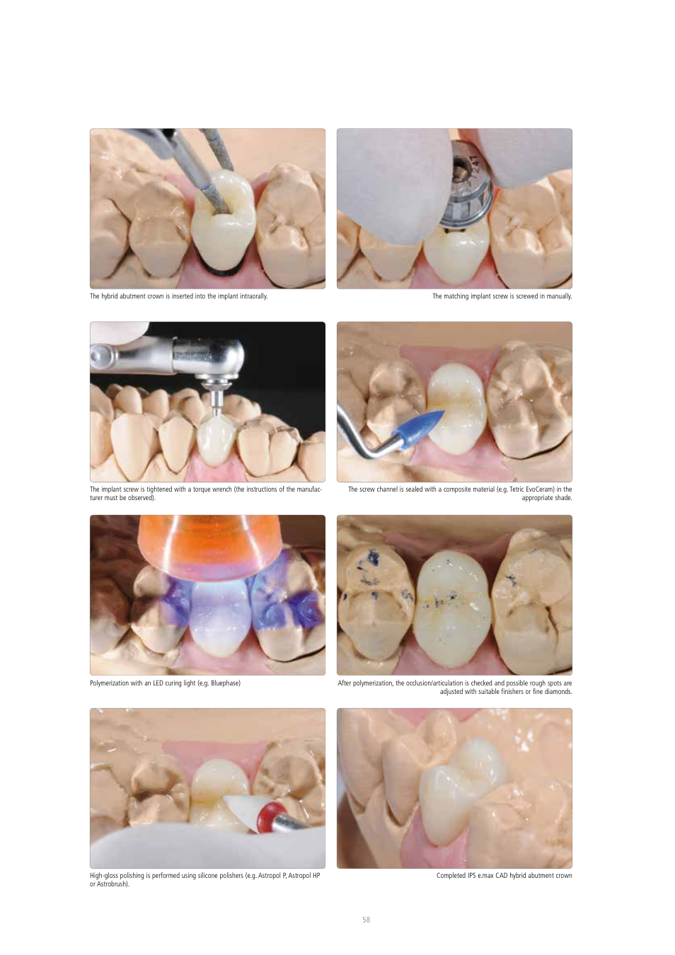 Ivoclar Vivadent IPS e.max CAD Abutment Solutions User Manual | Page 58 / 66