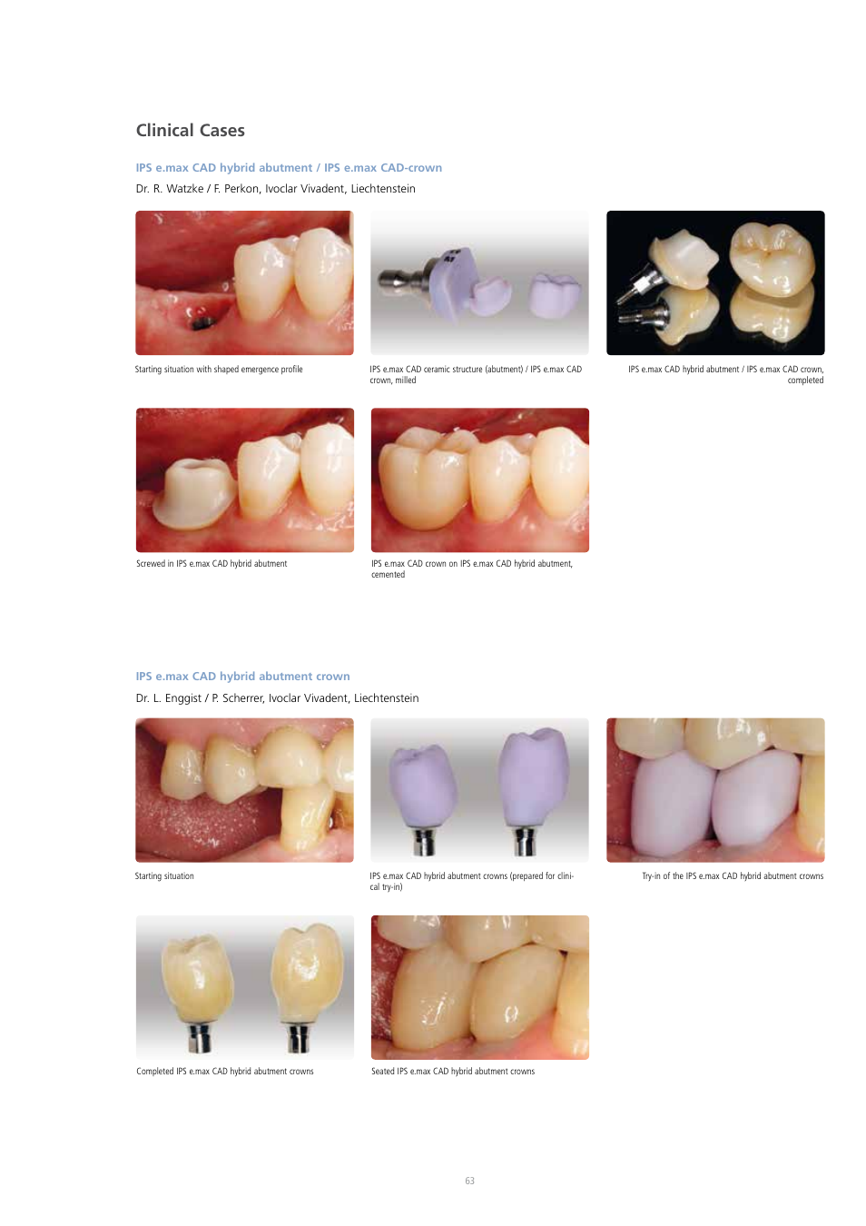 Clinical cases | Ivoclar Vivadent IPS e.max CAD Abutment Solutions User Manual | Page 63 / 66