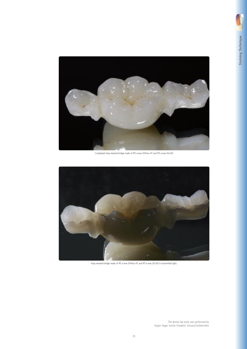 Ivoclar Vivadent IPS e.max ZirPress User Manual | Page 35 / 76