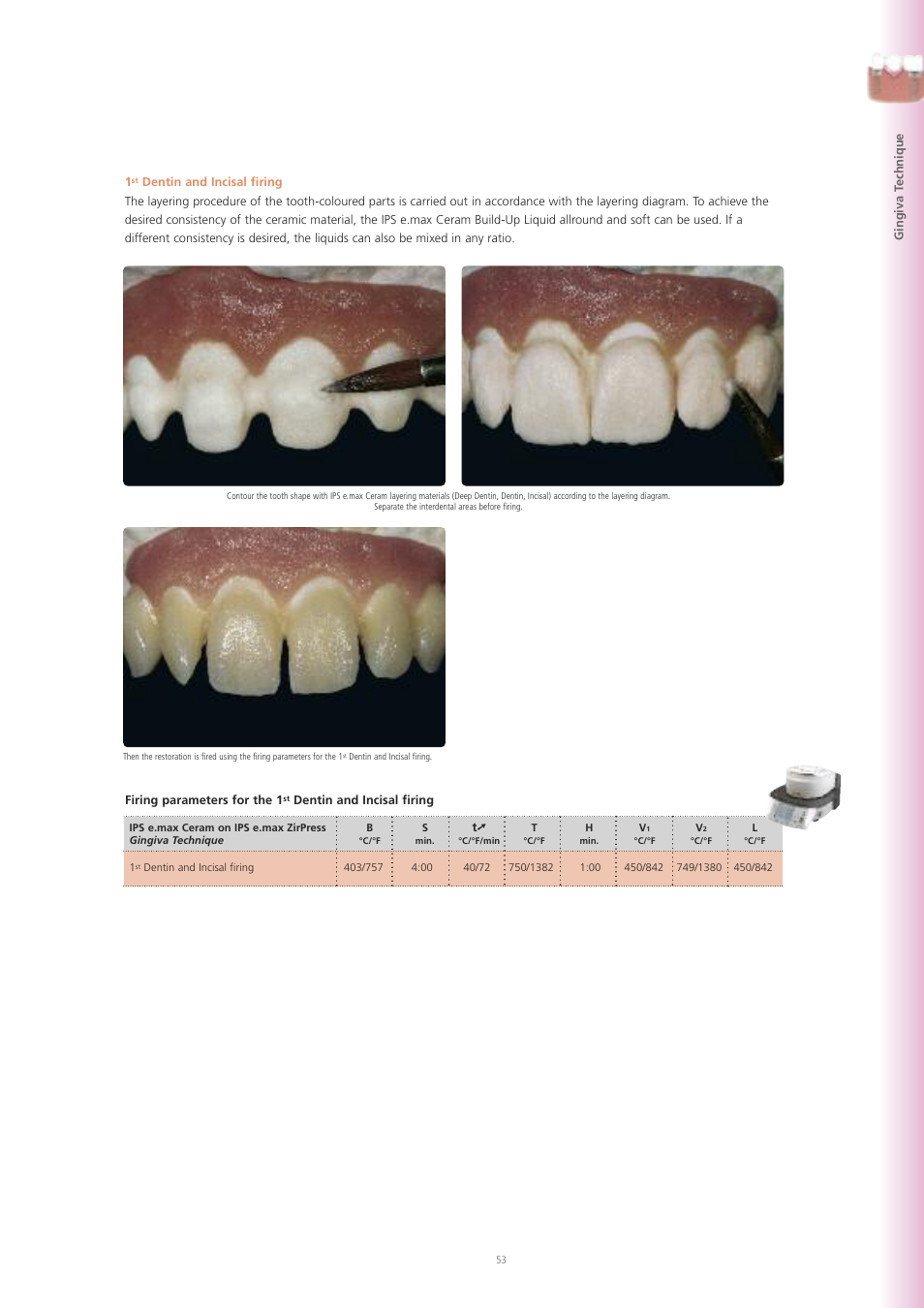 Ivoclar Vivadent IPS e.max ZirPress User Manual | Page 53 / 76