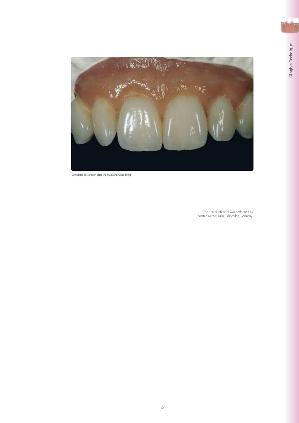 Ivoclar Vivadent IPS e.max ZirPress User Manual | Page 55 / 76