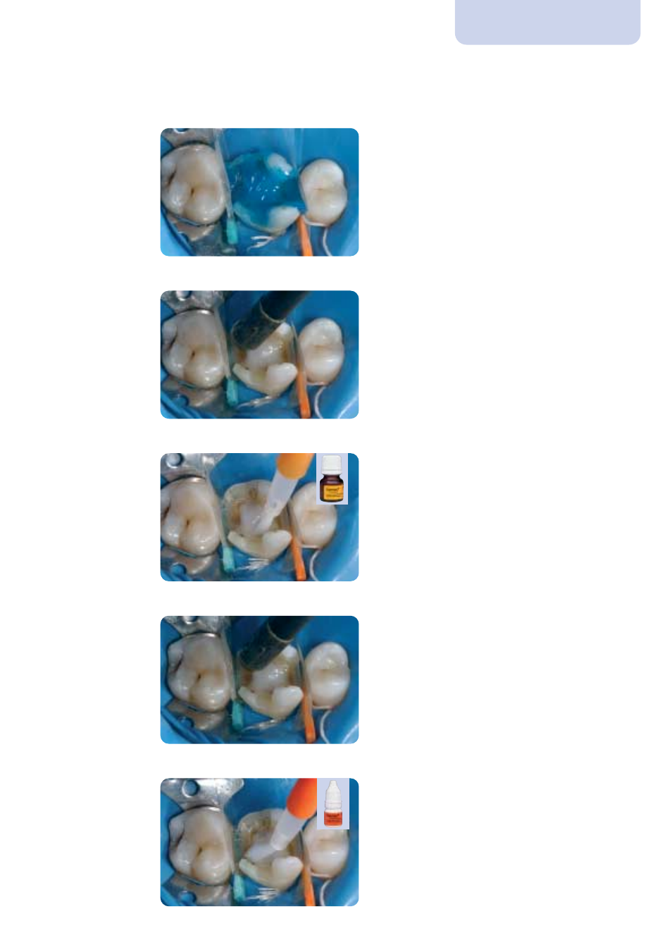 Step by step | Ivoclar Vivadent IPS Empress Esthetic Clinical User Manual | Page 19 / 28