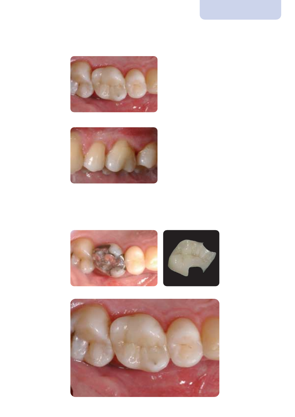 Step by step | Ivoclar Vivadent IPS Empress Esthetic Clinical User Manual | Page 21 / 28