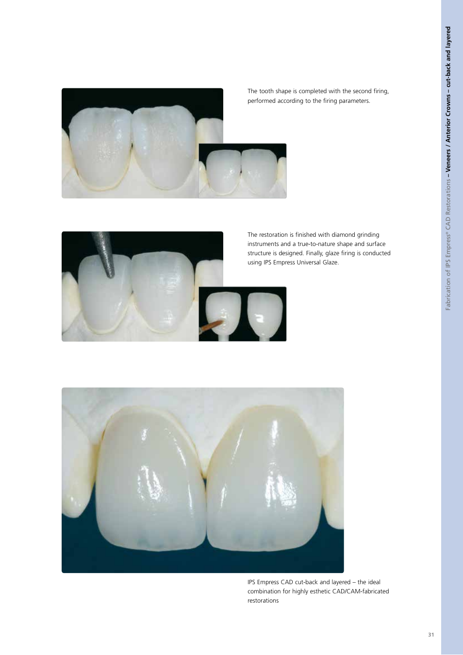 Empress, Veneers / anterior crowns – cut-back and layered | Ivoclar Vivadent PS Empress CAD Chairside User Manual | Page 31 / 40