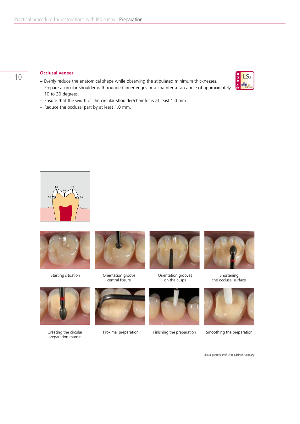 Preparation | Ivoclar Vivadent IPS e.max Clinical Guide User Manual | Page 10 / 44