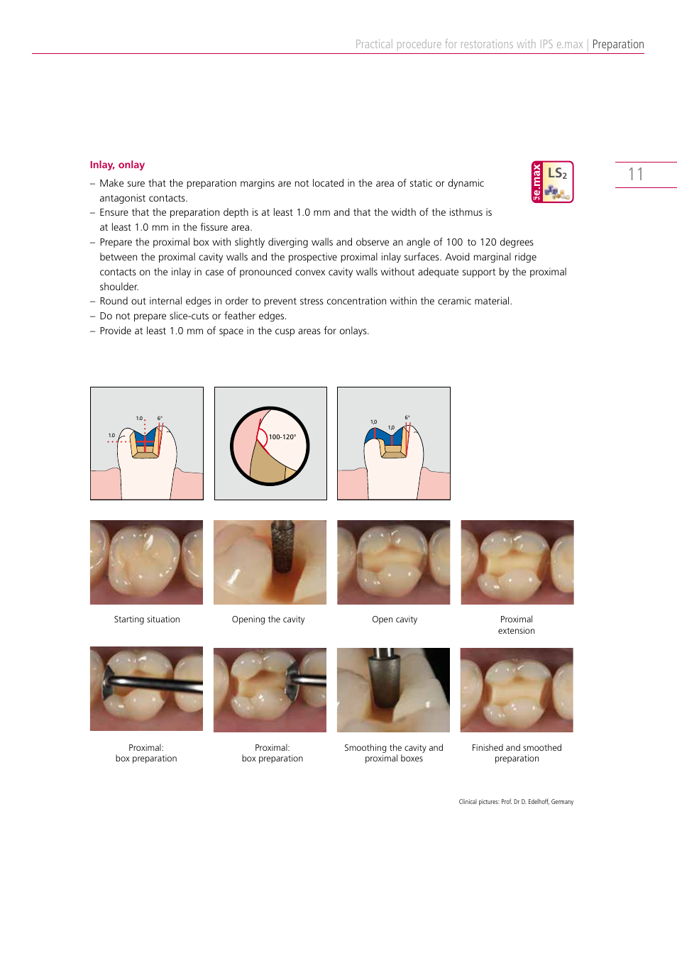 Preparation | Ivoclar Vivadent IPS e.max Clinical Guide User Manual | Page 11 / 44