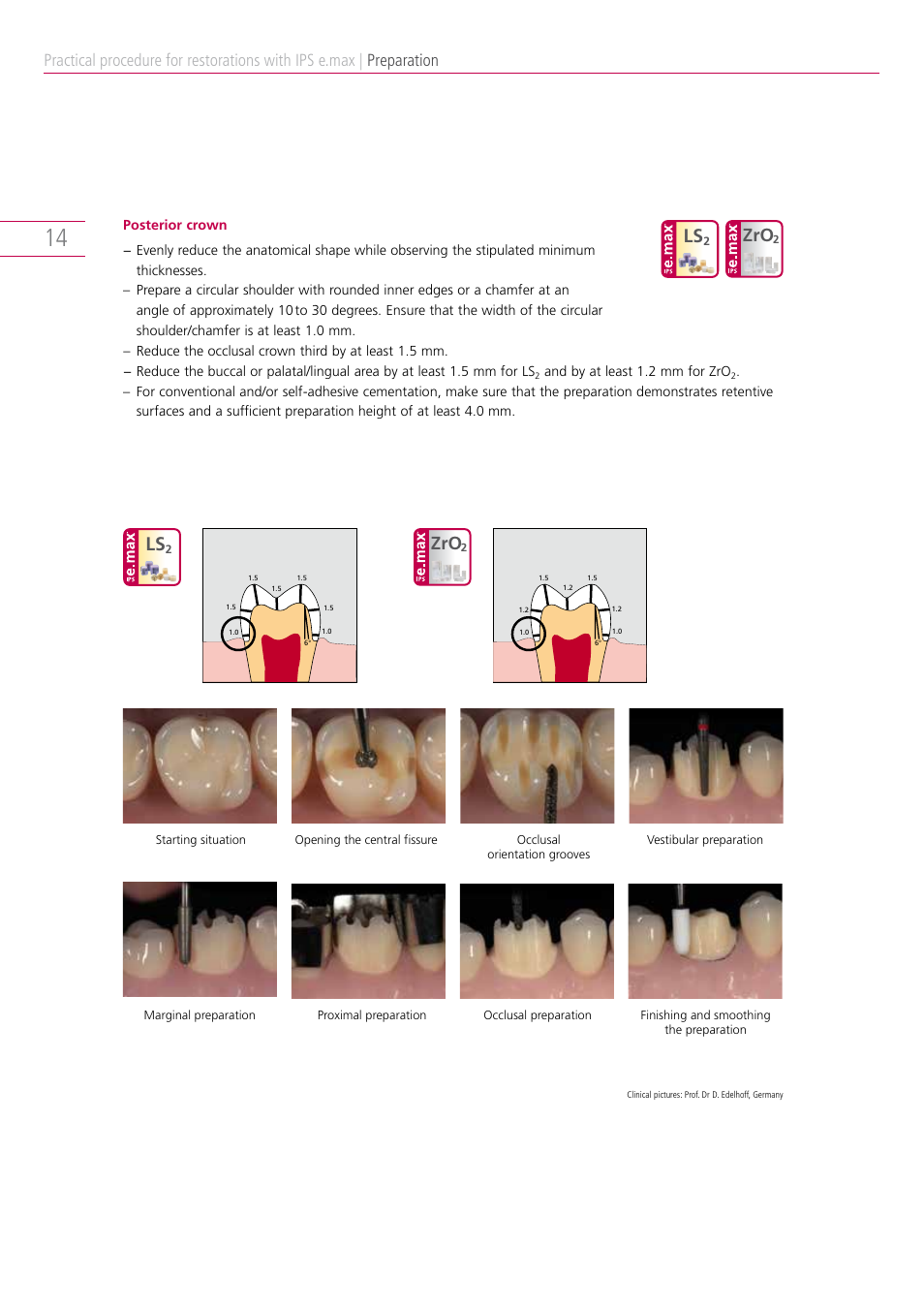 Preparation | Ivoclar Vivadent IPS e.max Clinical Guide User Manual | Page 14 / 44