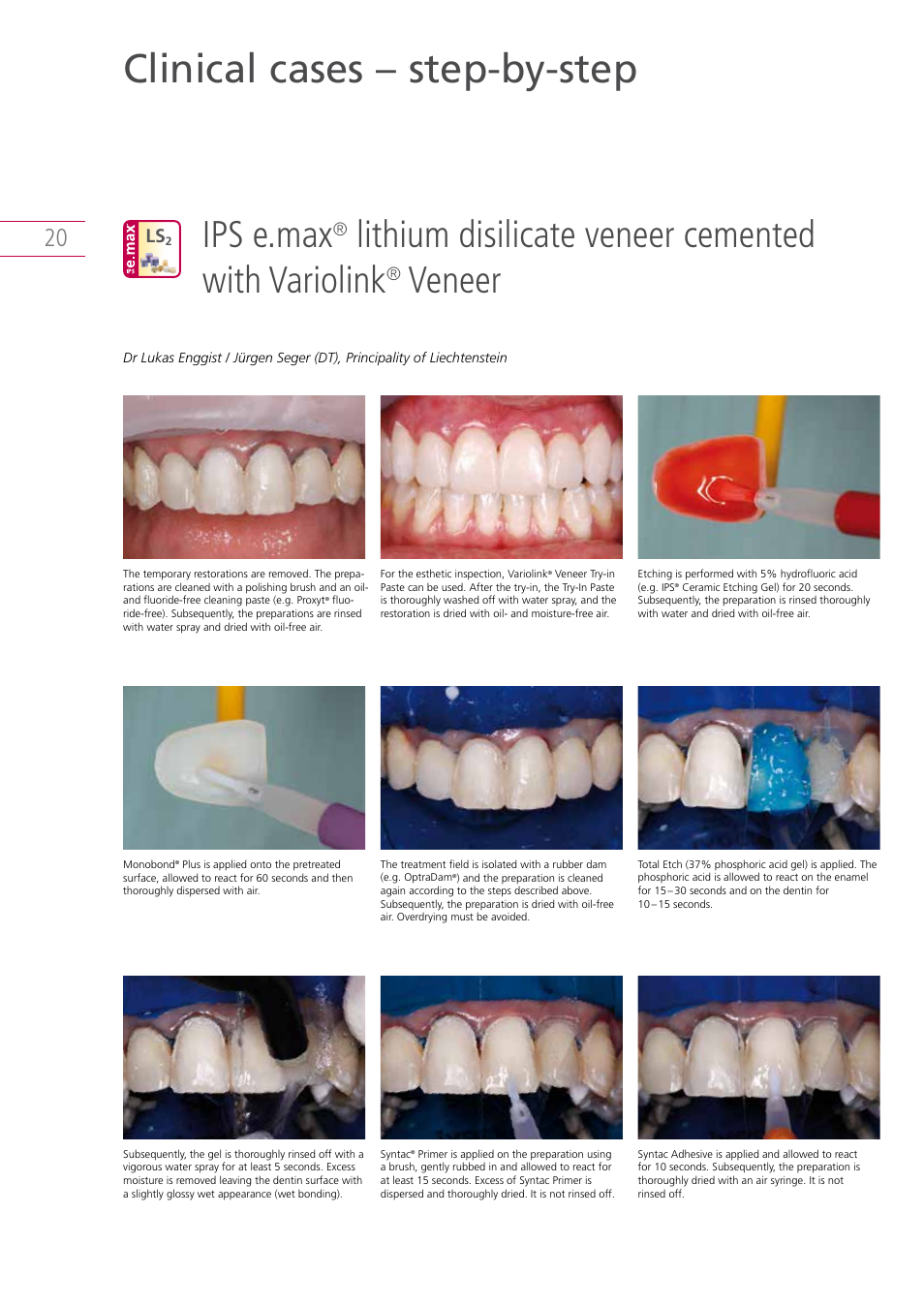 Clinical cases – step-by-step, Ips e.max, Lithium disilicate veneer cemented with variolink | Veneer | Ivoclar Vivadent IPS e.max Clinical Guide User Manual | Page 20 / 44