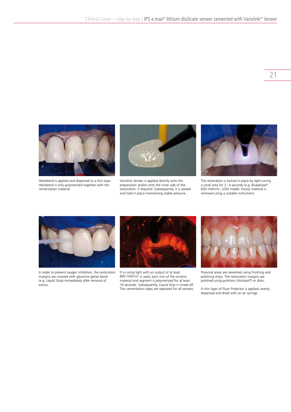 Clinical cases – step-by-step, Ips e.max, Lithium disilicate veneer cemented with variolink | Veneer | Ivoclar Vivadent IPS e.max Clinical Guide User Manual | Page 21 / 44