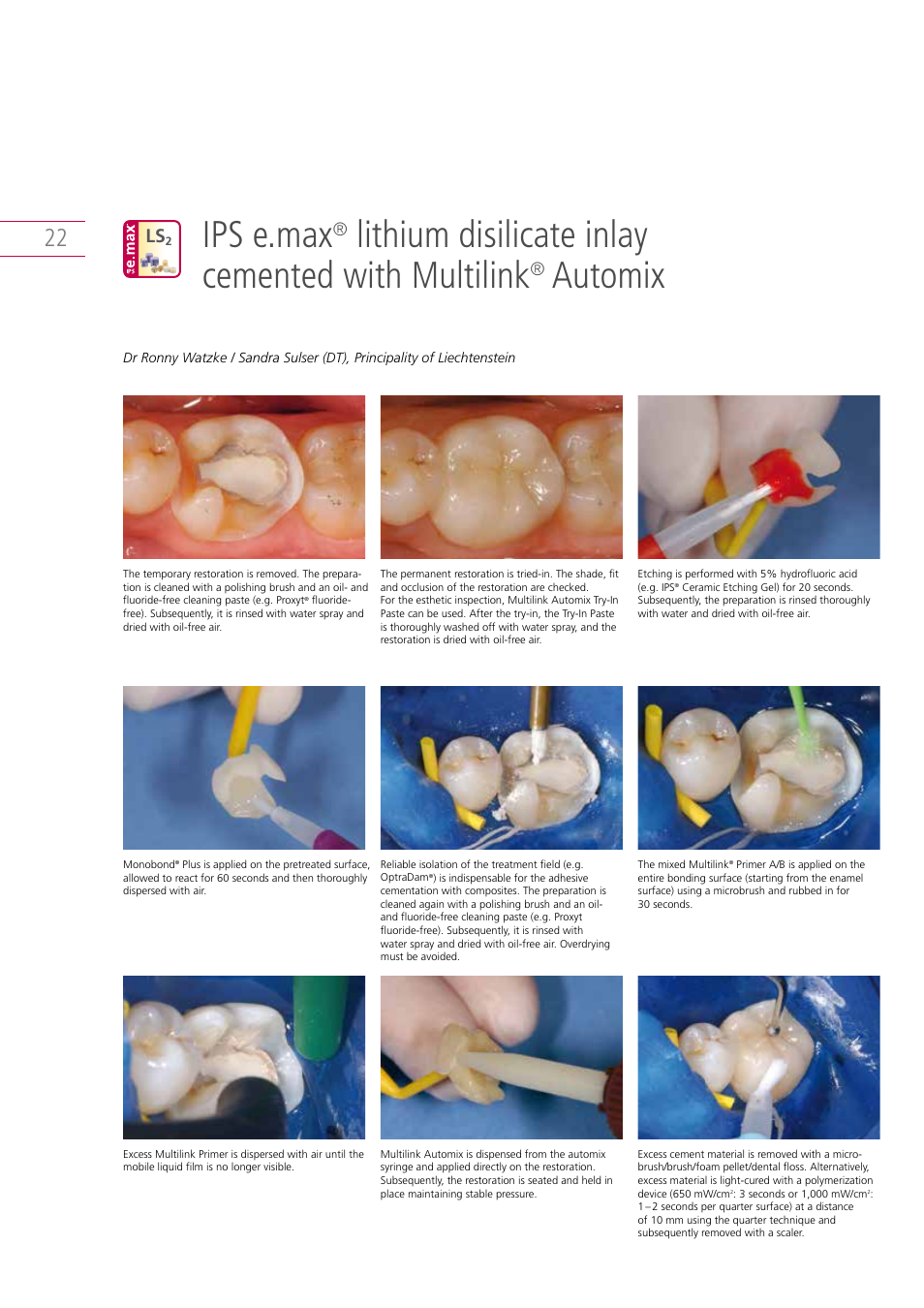 Ips e.max, Lithium disilicate inlay cemented with multilink, Automix | Ivoclar Vivadent IPS e.max Clinical Guide User Manual | Page 22 / 44