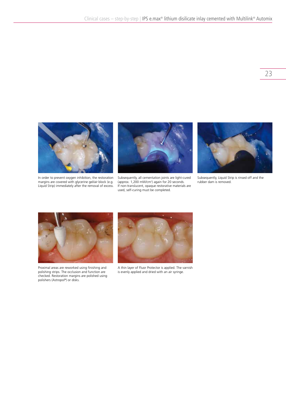 Clinical cases – step-by-step, Ips e.max, Lithium disilicate inlay cemented with multilink | Automix | Ivoclar Vivadent IPS e.max Clinical Guide User Manual | Page 23 / 44