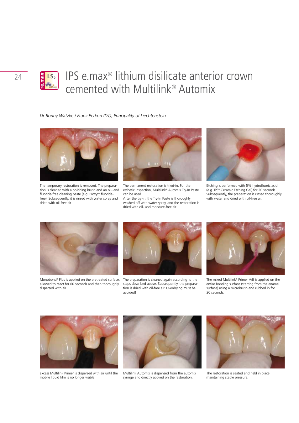 Ips e.max, Automix | Ivoclar Vivadent IPS e.max Clinical Guide User Manual | Page 24 / 44