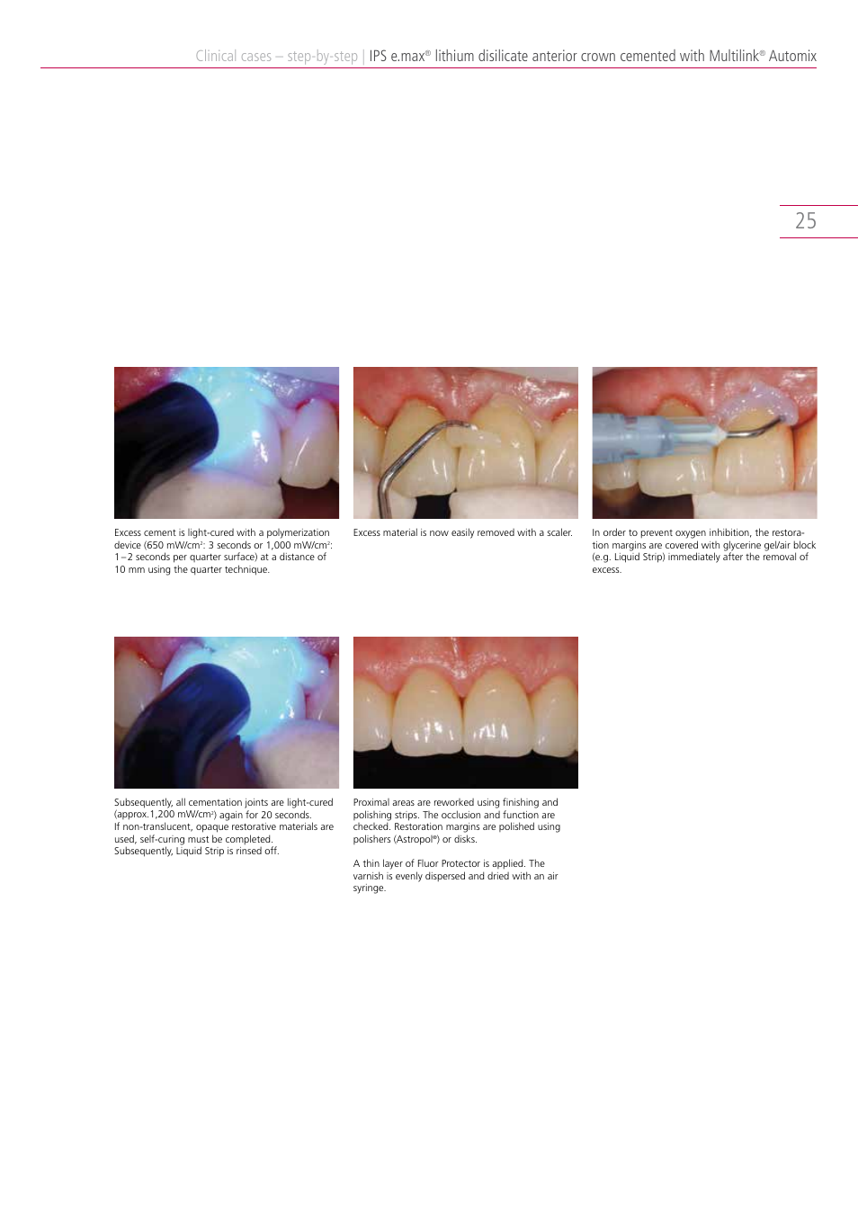 Clinical cases – step-by-step, Ips e.max, Automix | Ivoclar Vivadent IPS e.max Clinical Guide User Manual | Page 25 / 44