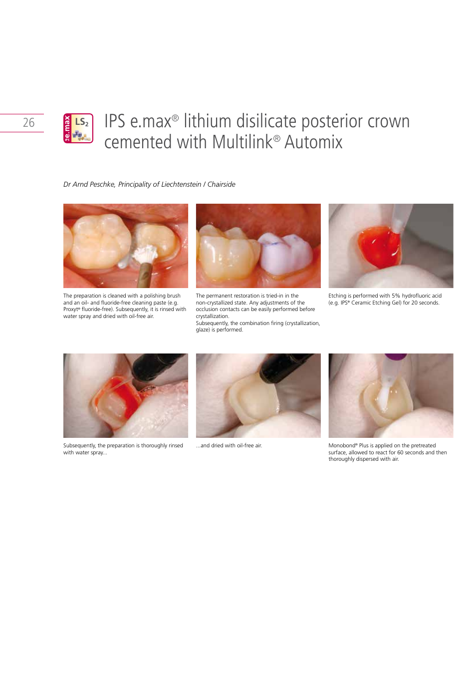 Ips e.max, Automix | Ivoclar Vivadent IPS e.max Clinical Guide User Manual | Page 26 / 44