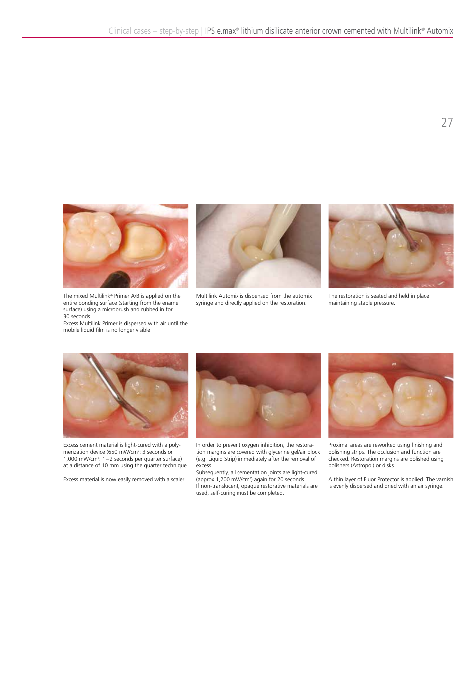 Clinical cases – step-by-step, Ips e.max, Automix | Ivoclar Vivadent IPS e.max Clinical Guide User Manual | Page 27 / 44