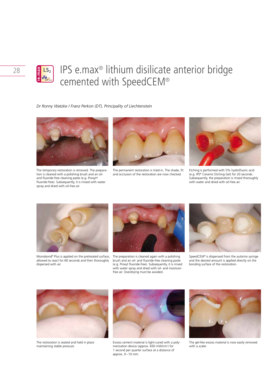 Ips e.max | Ivoclar Vivadent IPS e.max Clinical Guide User Manual | Page 28 / 44