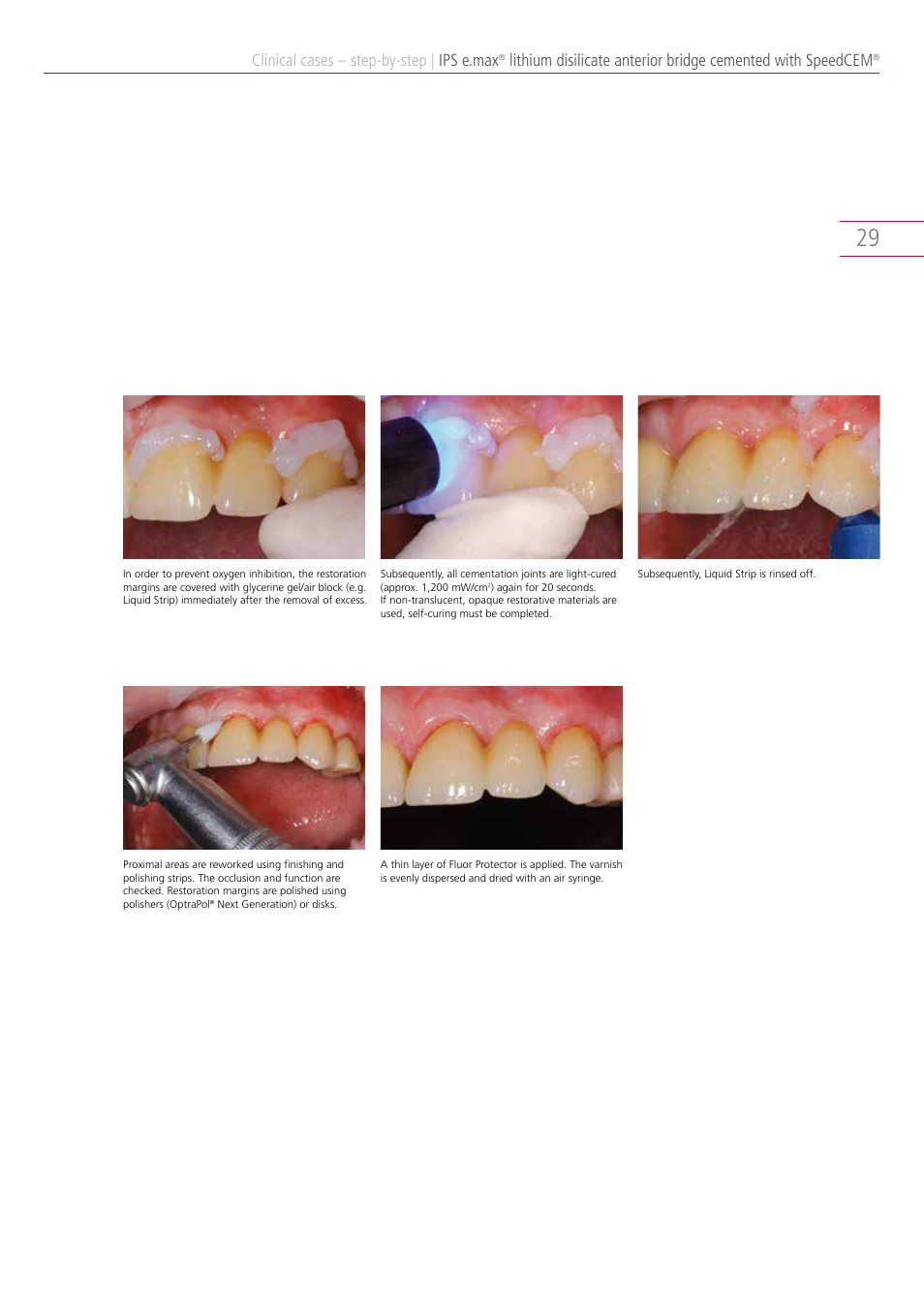 Clinical cases – step-by-step, Ips e.max | Ivoclar Vivadent IPS e.max Clinical Guide User Manual | Page 29 / 44