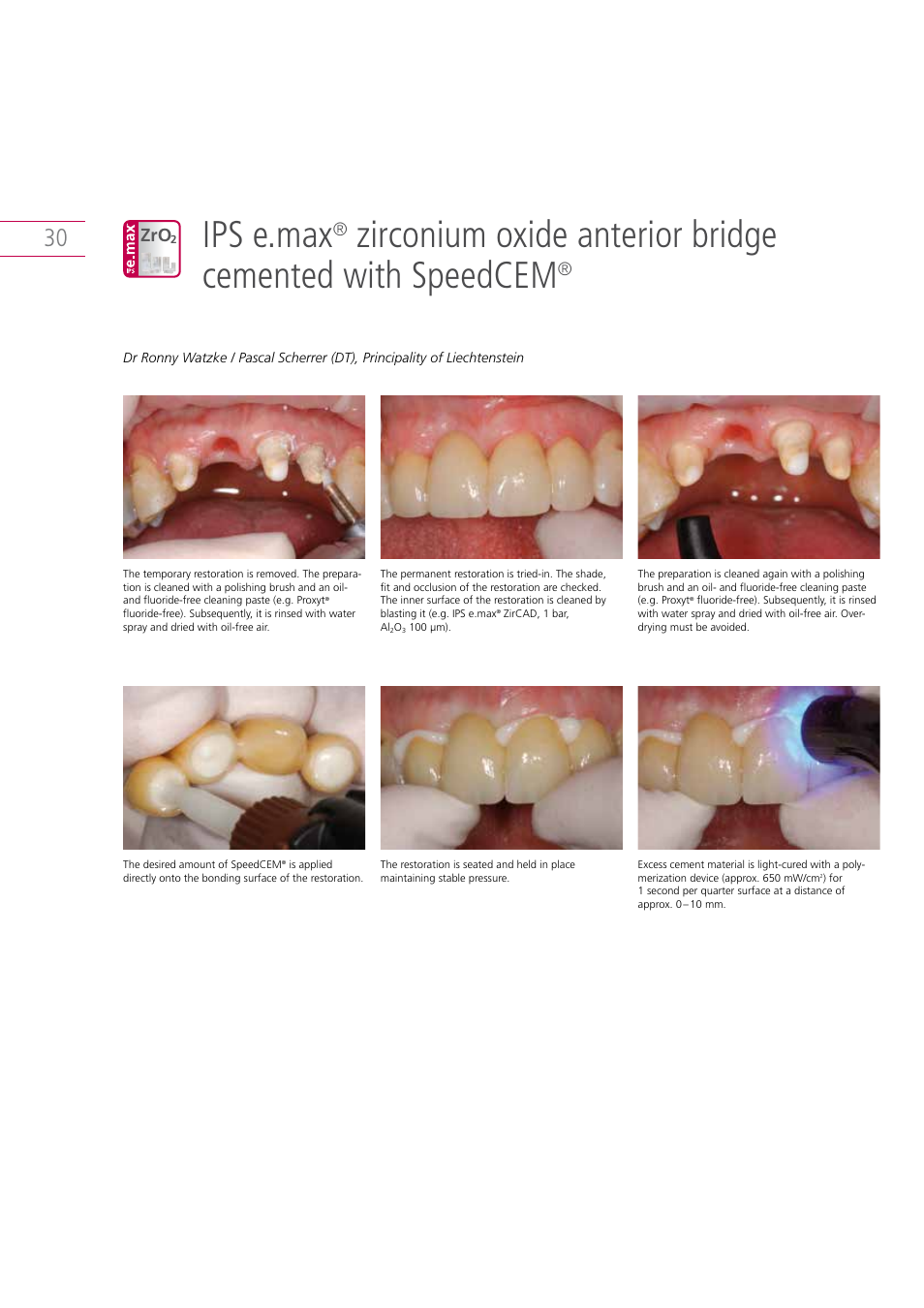 Ips e.max | Ivoclar Vivadent IPS e.max Clinical Guide User Manual | Page 30 / 44