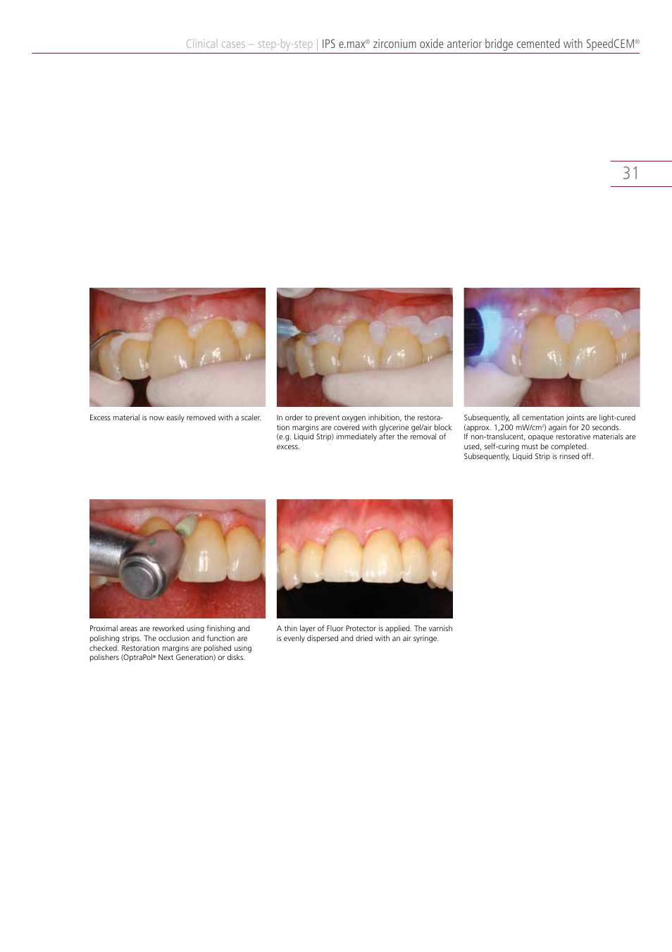 Clinical cases – step-by-step, Ips e.max | Ivoclar Vivadent IPS e.max Clinical Guide User Manual | Page 31 / 44