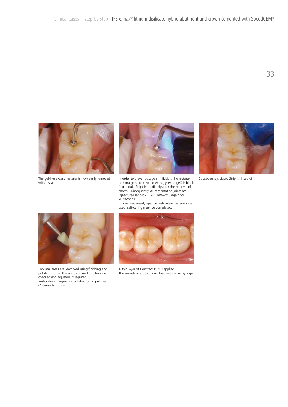 Clinical cases – step-by-step, Ips e.max | Ivoclar Vivadent IPS e.max Clinical Guide User Manual | Page 33 / 44