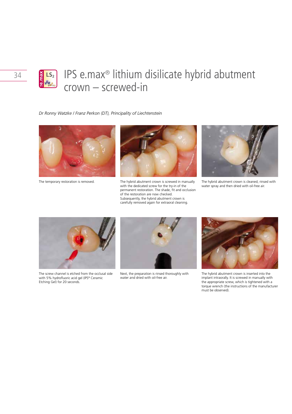 Ips e.max | Ivoclar Vivadent IPS e.max Clinical Guide User Manual | Page 34 / 44