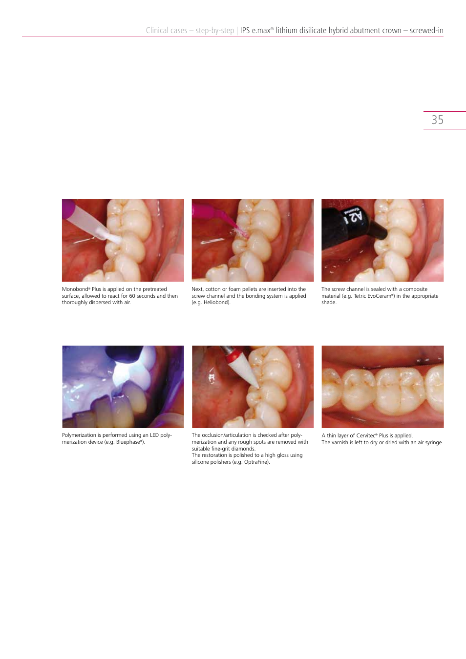 Clinical cases – step-by-step, Ips e.max | Ivoclar Vivadent IPS e.max Clinical Guide User Manual | Page 35 / 44