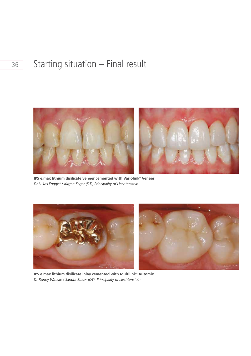 Starting situation – final result | Ivoclar Vivadent IPS e.max Clinical Guide User Manual | Page 36 / 44