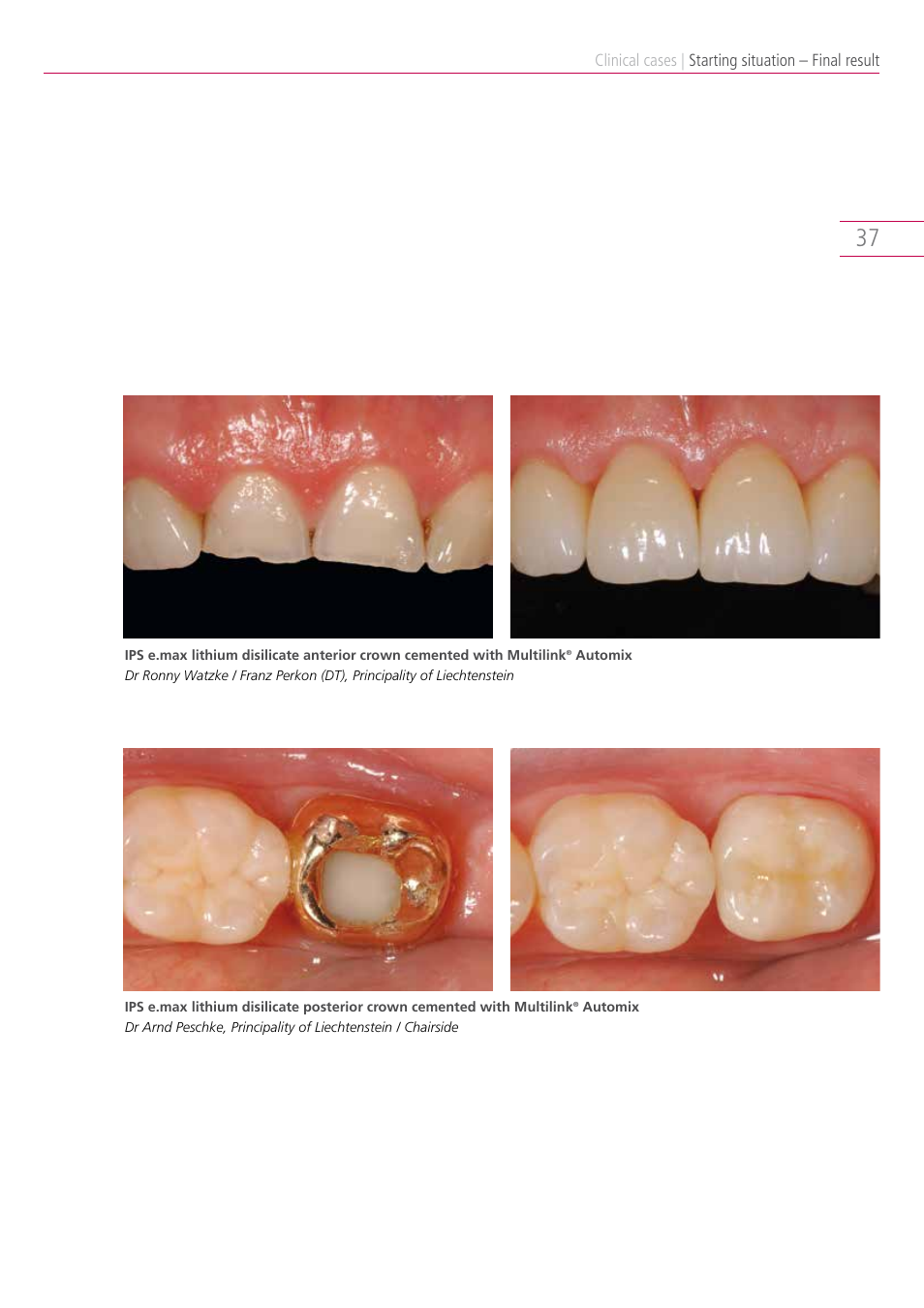 Ivoclar Vivadent IPS e.max Clinical Guide User Manual | Page 37 / 44