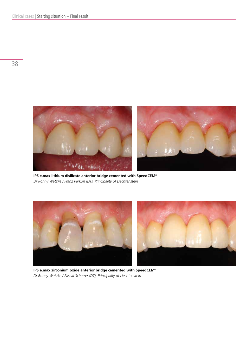 Ivoclar Vivadent IPS e.max Clinical Guide User Manual | Page 38 / 44