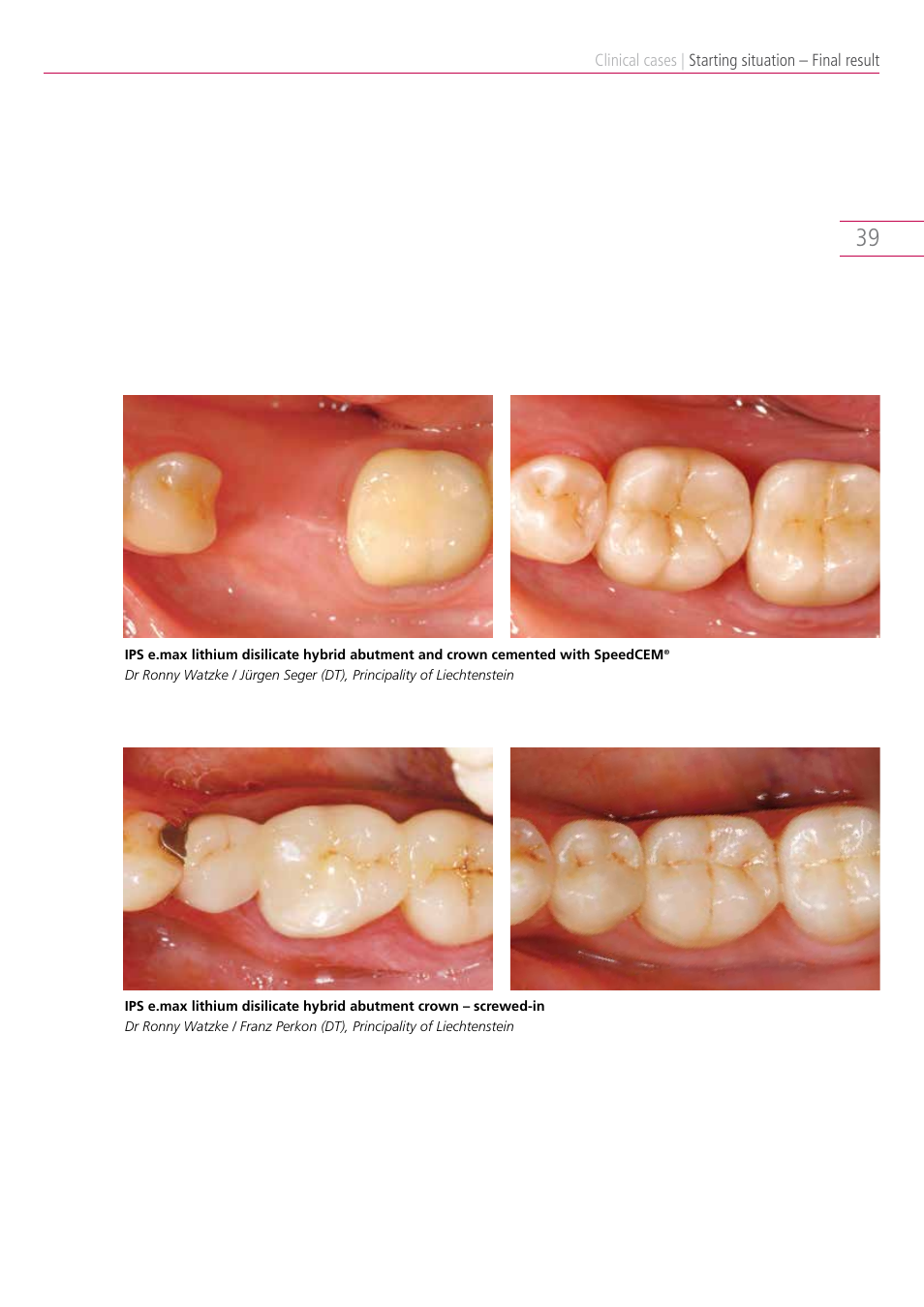 Ivoclar Vivadent IPS e.max Clinical Guide User Manual | Page 39 / 44