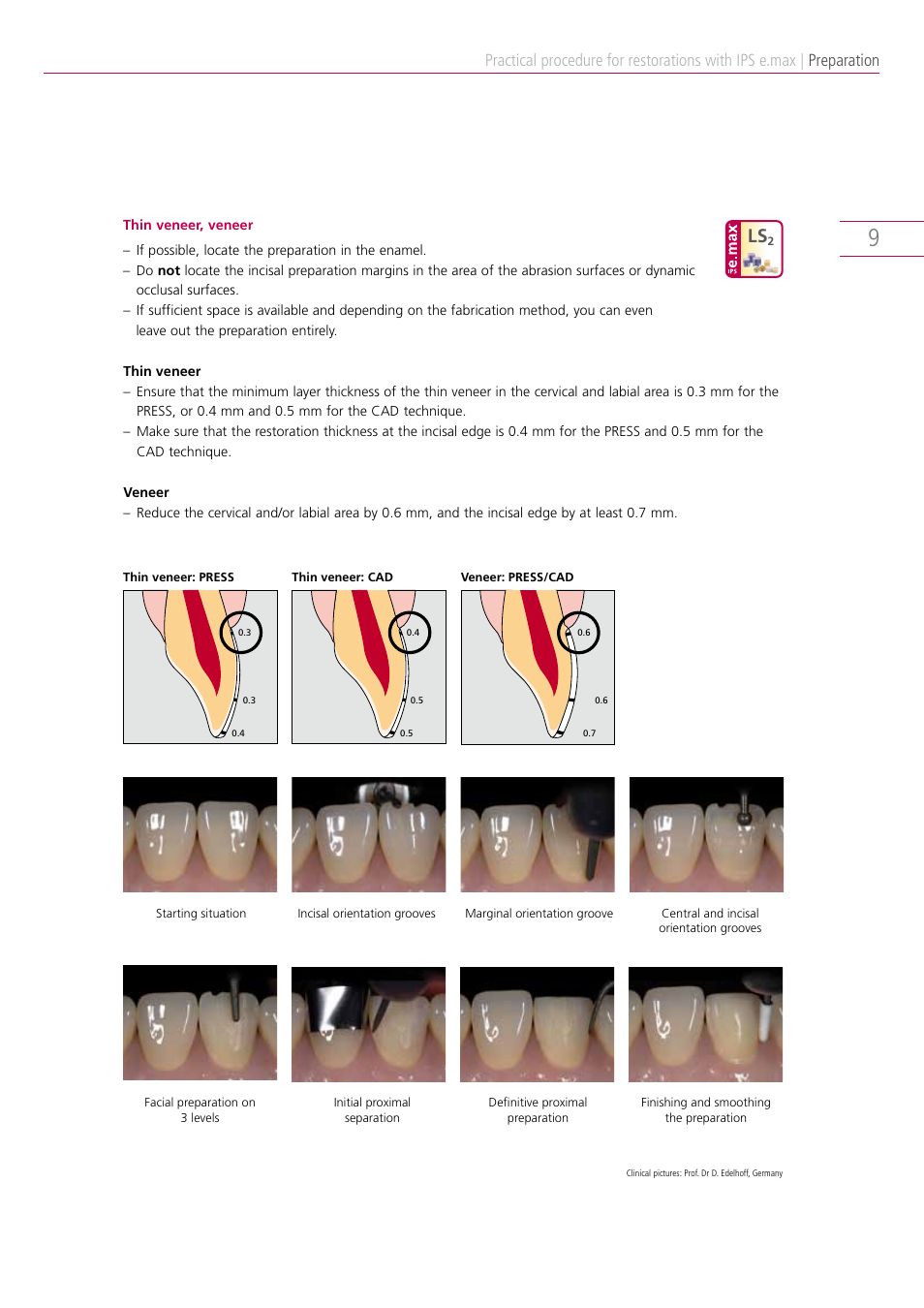 Preparation | Ivoclar Vivadent IPS e.max Clinical Guide User Manual | Page 9 / 44