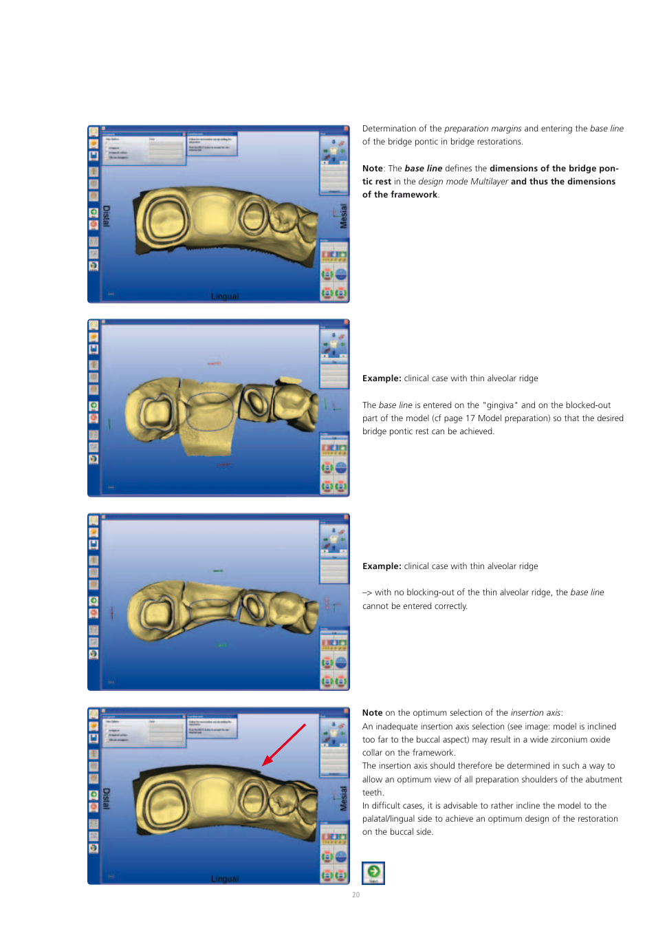 Ivoclar Vivadent IPS e.max CAD-on User Manual | Page 20 / 52