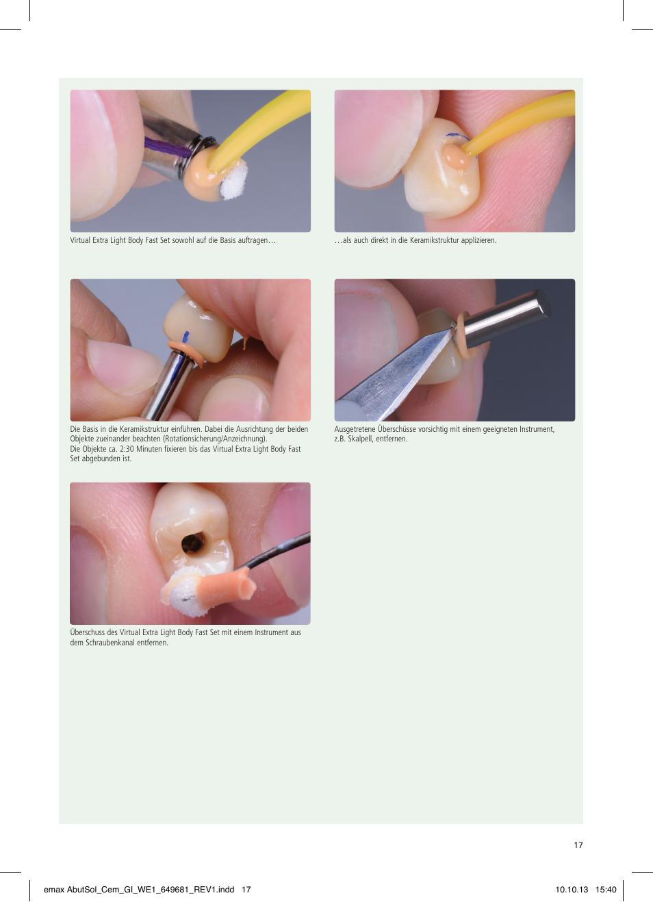 Ivoclar Vivadent IPS e.max Abutment Solutions Cem Kit User Manual | Page 17 / 80