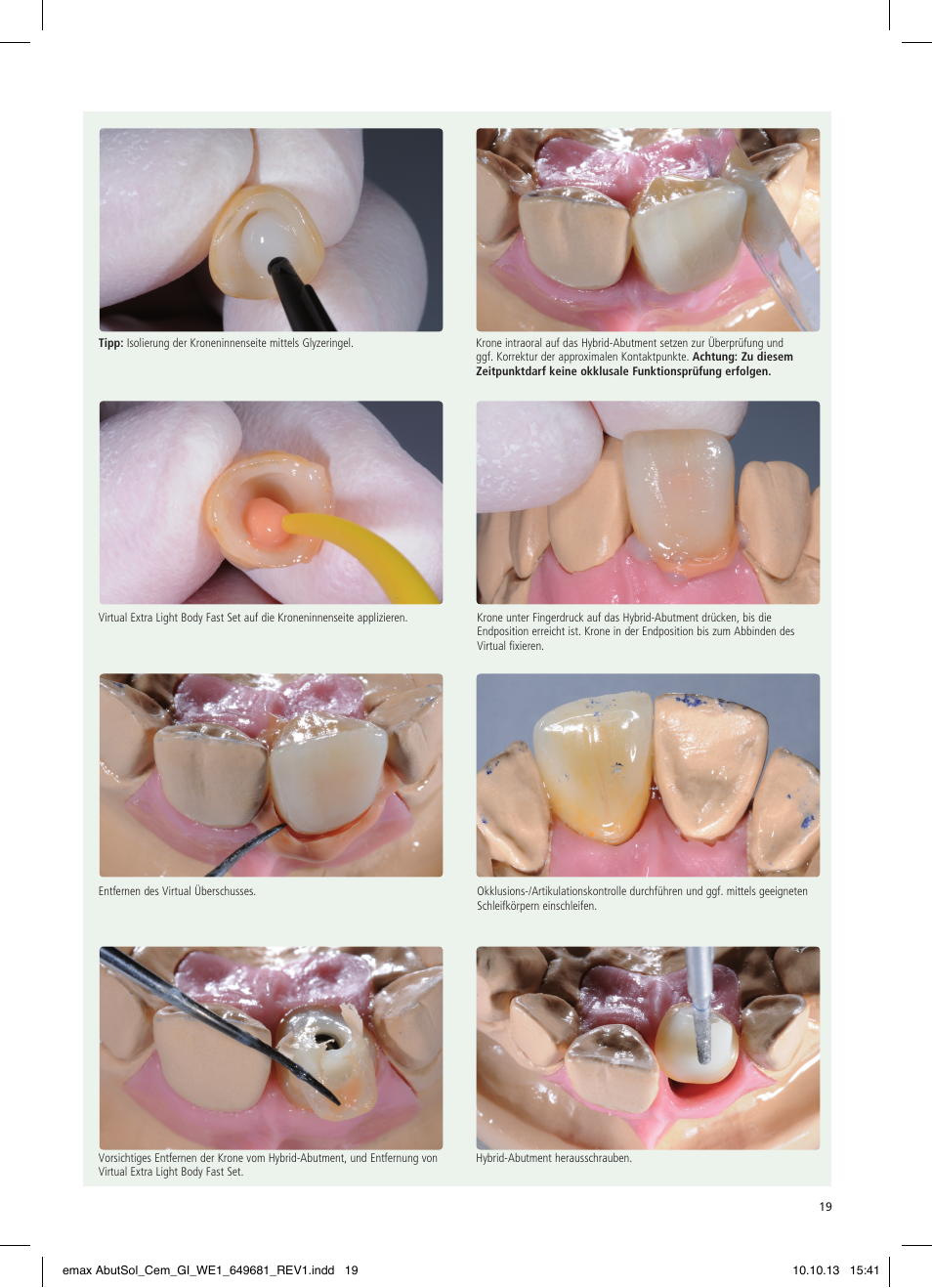 Ivoclar Vivadent IPS e.max Abutment Solutions Cem Kit User Manual | Page 19 / 80