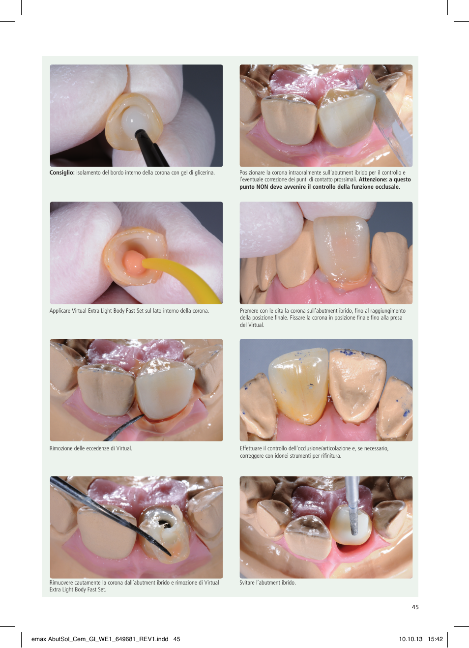 Ivoclar Vivadent IPS e.max Abutment Solutions Cem Kit User Manual | Page 45 / 80