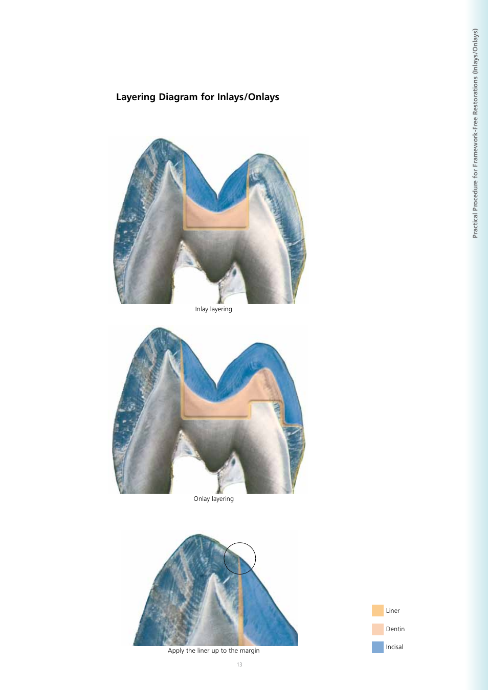 Layering diagram for inlays/onlays | Ivoclar Vivadent SR Adoro User Manual | Page 13 / 88