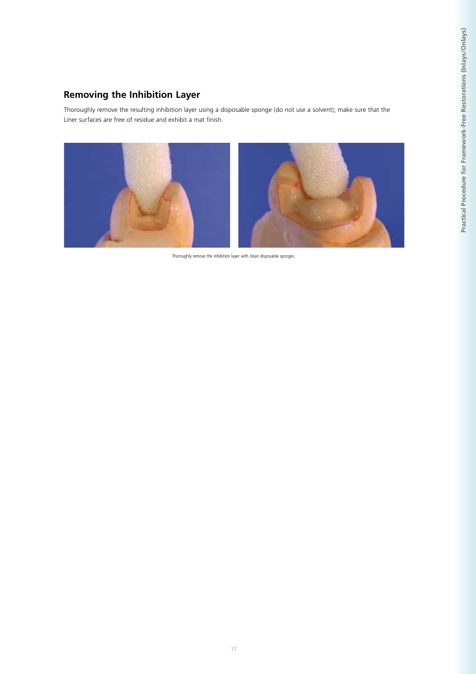 Removing the inhibition layer | Ivoclar Vivadent SR Adoro User Manual | Page 17 / 88