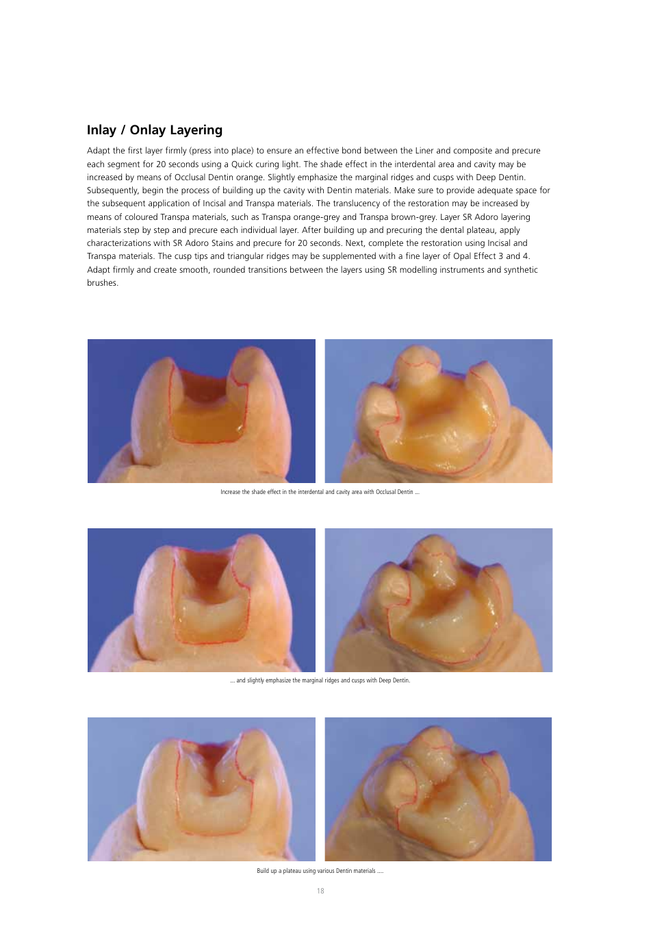 Inlay / onlay layering | Ivoclar Vivadent SR Adoro User Manual | Page 18 / 88