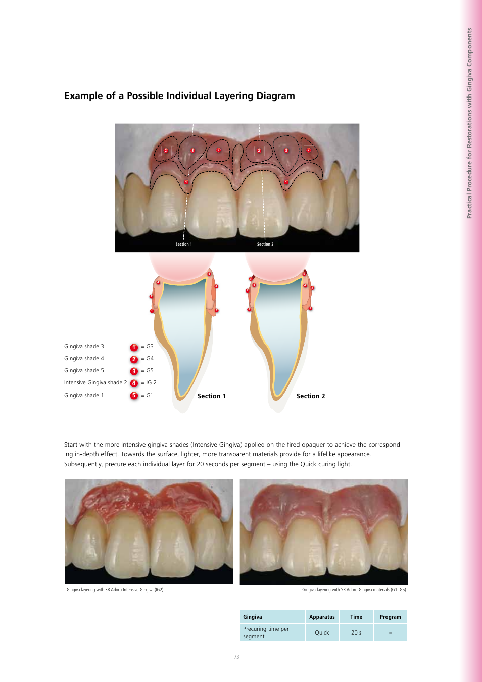 Example of a possible individual layering diagram | Ivoclar Vivadent SR Adoro User Manual | Page 73 / 88