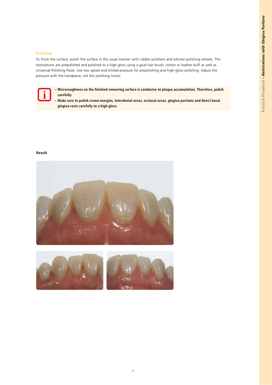 Ivoclar Vivadent SR Nexco Paste User Manual | Page 55 / 64