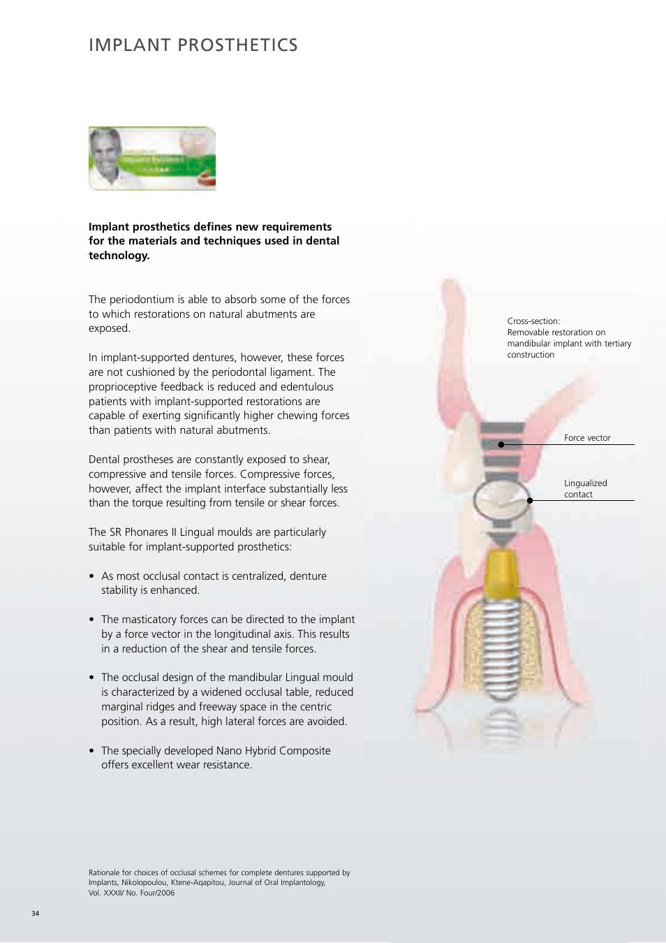 Implant prosthetics | Ivoclar Vivadent SR Phonares II User Manual | Page 34 / 40