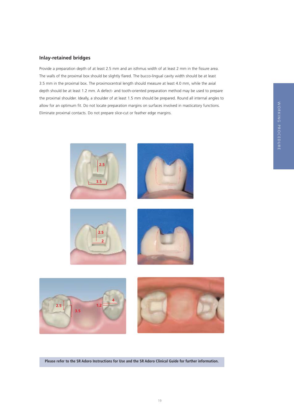 Inlay-retained bridges | Ivoclar Vivadent Vectris User Manual | Page 19 / 60