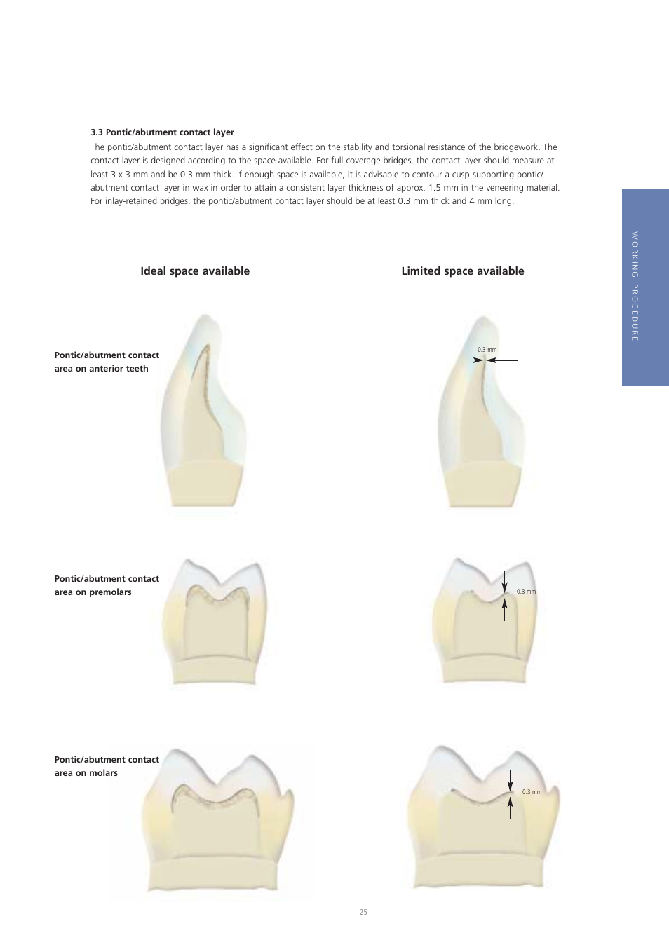 Limited space available ideal space available | Ivoclar Vivadent Vectris User Manual | Page 25 / 60