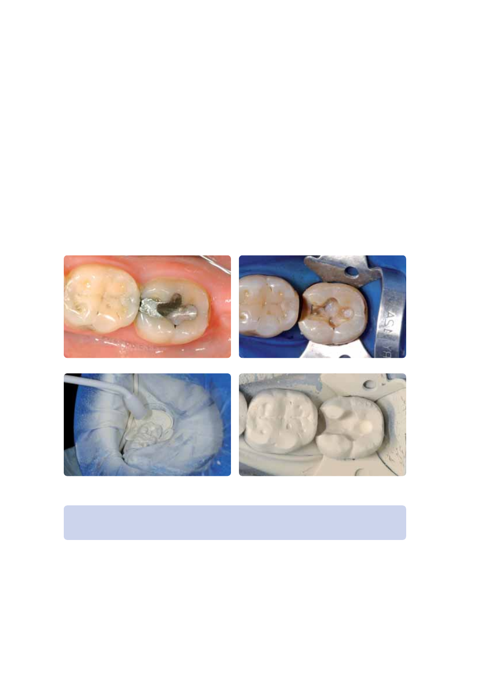 Herstellung der ips empress cad restauration, Ips empress cad inlays / onlays – poliert | Ivoclar Vivadent IPS Empress CAD Chairside - de-en-es-it-ru User Manual | Page 20 / 240