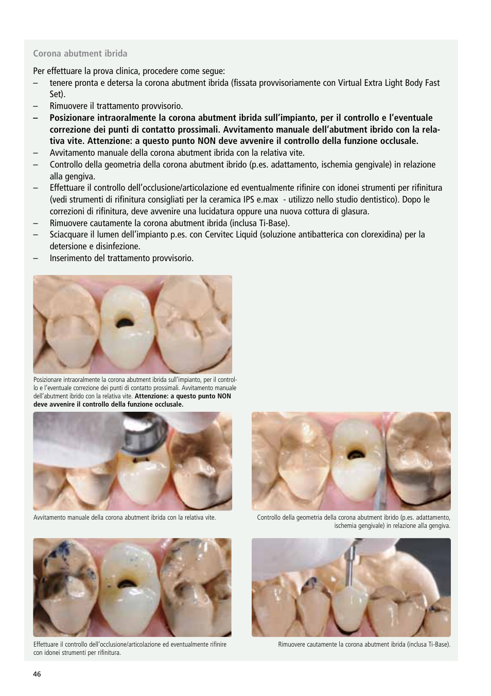 Ivoclar Vivadent IPS e.max Abutment Solutions Cem Kit v.3 User Manual | Page 46 / 80