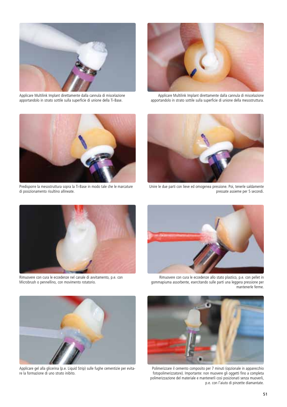 Ivoclar Vivadent IPS e.max Abutment Solutions Cem Kit v.3 User Manual | Page 51 / 80